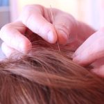 Agopuntura per la gestione della cefalea cronica: una revisione sistematica